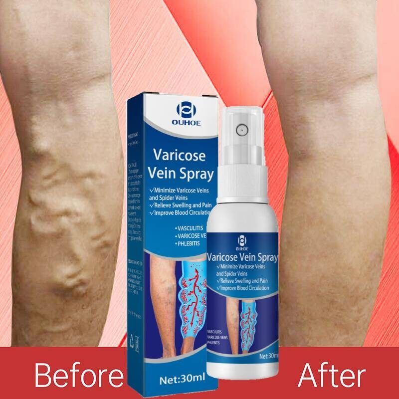 Varicose Vein Spray Relief Veins Minimize Varicose Veins and Spider Veins
